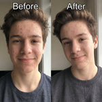 Before and after acne treatment results using ENCA acne clearing cleanser and moisturiser set