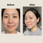 Acne clearing before and after results using ENCA cleanser and moisturiser skincare set
